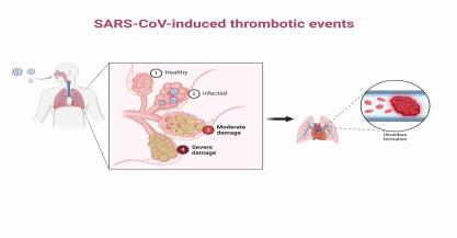 Management and Treatment of SARS-CoV-induced thrombotic events