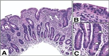 Integrating Clinical Features with Mucosal Biopsy Findings for Precise Diagnosis of Malabsorption Syndromes
